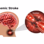 Warning Signs of Ischemic Stroke You Should Know