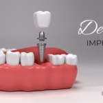 dental implants in sydney